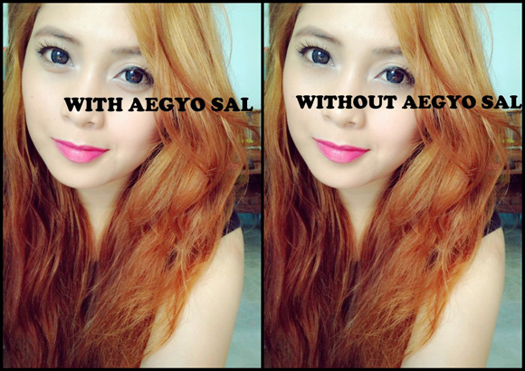 ศัลยกรรมถุงใต้ตา