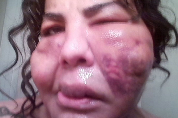 ฟิลเลอร์