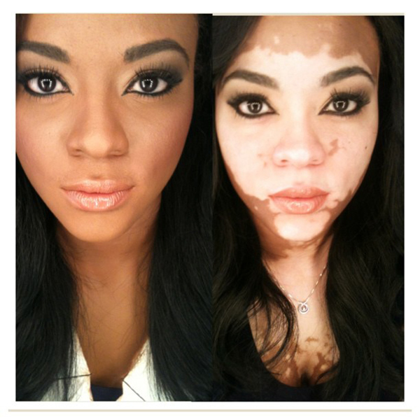  โรคด่างขาว