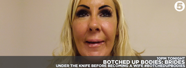 ฟิลเลอร์