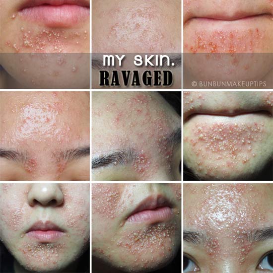 วิธีรักษาสิว