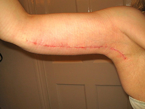 ศัลยกรรมต้นแขน