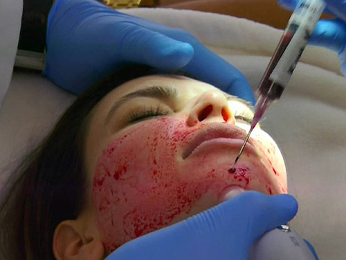 ฟิลเลอร์เลือด