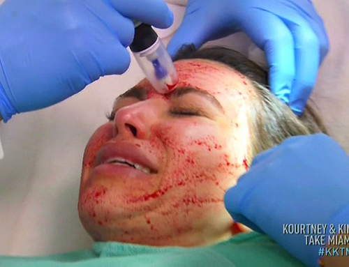 ฟิลเลอร์เลือด