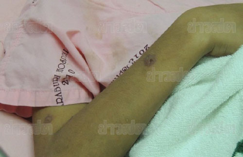 เด็ก 8 ขวบกินจิ้งหรีดทอด แพ้หนัก