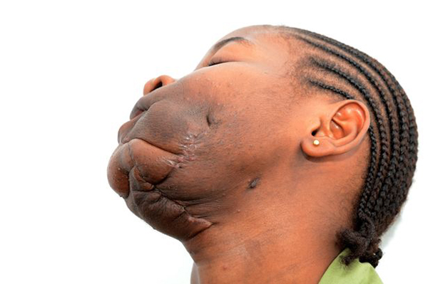 สาวคองโกเนื้องอกเต็มปาก ใหญ่เท่าลูกฟุตบอล