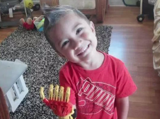 เด็กชายไร้นิ้วยิ้มร่า ได้แขนเทียมสุดเท่เหมือนไอรอนแมน