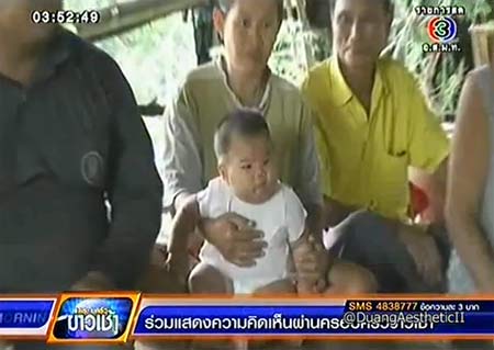 น้องเนย วัย 6 เดือน มีนิ้วมือ-นิ้วเท้า รวม 24 นิ้ว