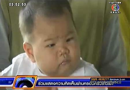 น้องเนย วัย 6 เดือน มีนิ้วมือ-นิ้วเท้า รวม 24 นิ้ว