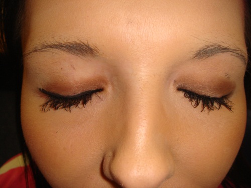 สาวขนตาโกร๋นตัดสินใจปลูกถ่ายขนตา เอาผมมาปลูกแทน!