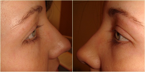 สาวขนตาโกร๋นตัดสินใจปลูกถ่ายขนตา เอาผมมาปลูกแทน!