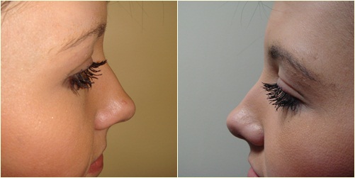 สาวขนตาโกร๋นตัดสินใจปลูกถ่ายขนตา เอาผมมาปลูกแทน!